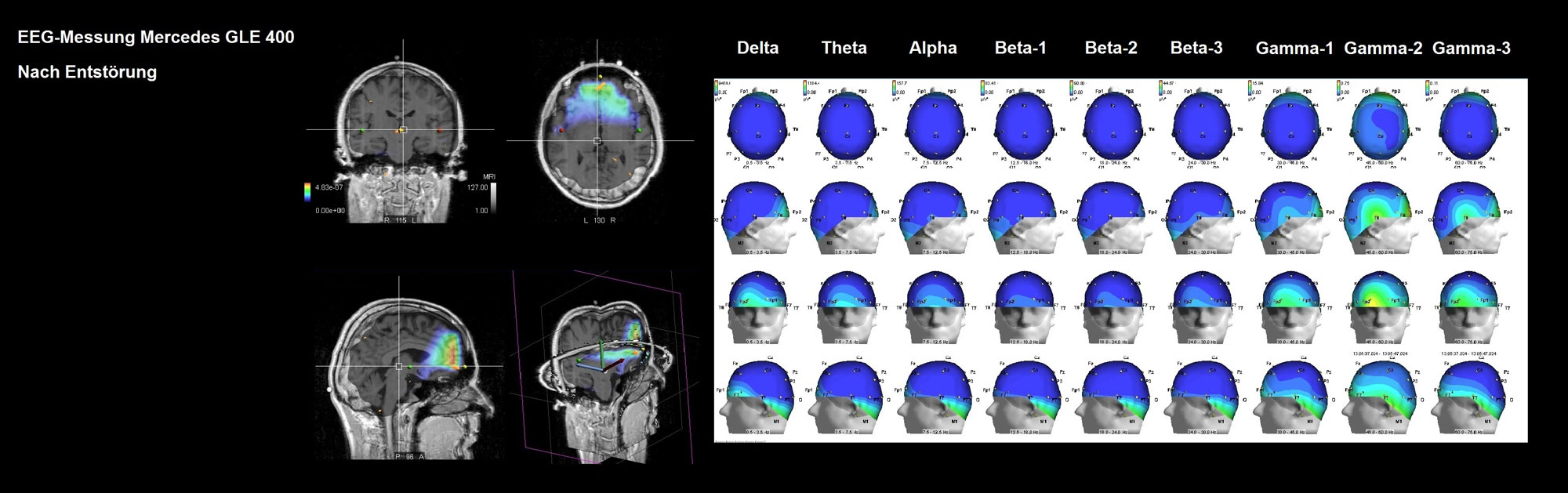 EEG-Messung-Mercedes-nach-der-Entstoerung-2000