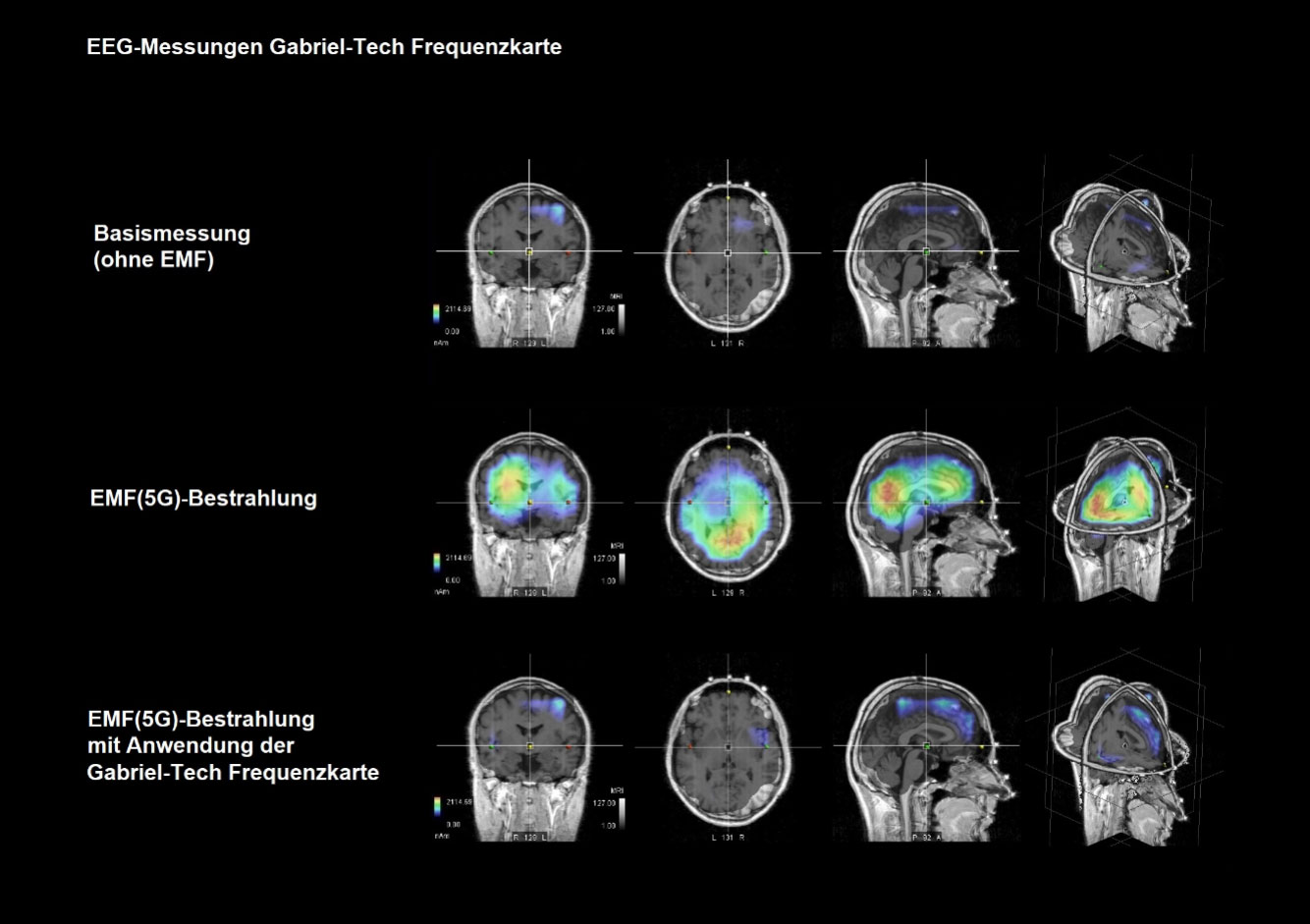 EEG-Messungen Gabriel-Frequenzkarte